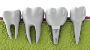 dental implants