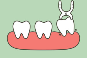 wisdom teeth Fort Worth