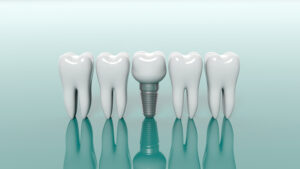 dental implants Fort Worth