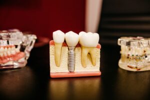 tooth implant model
