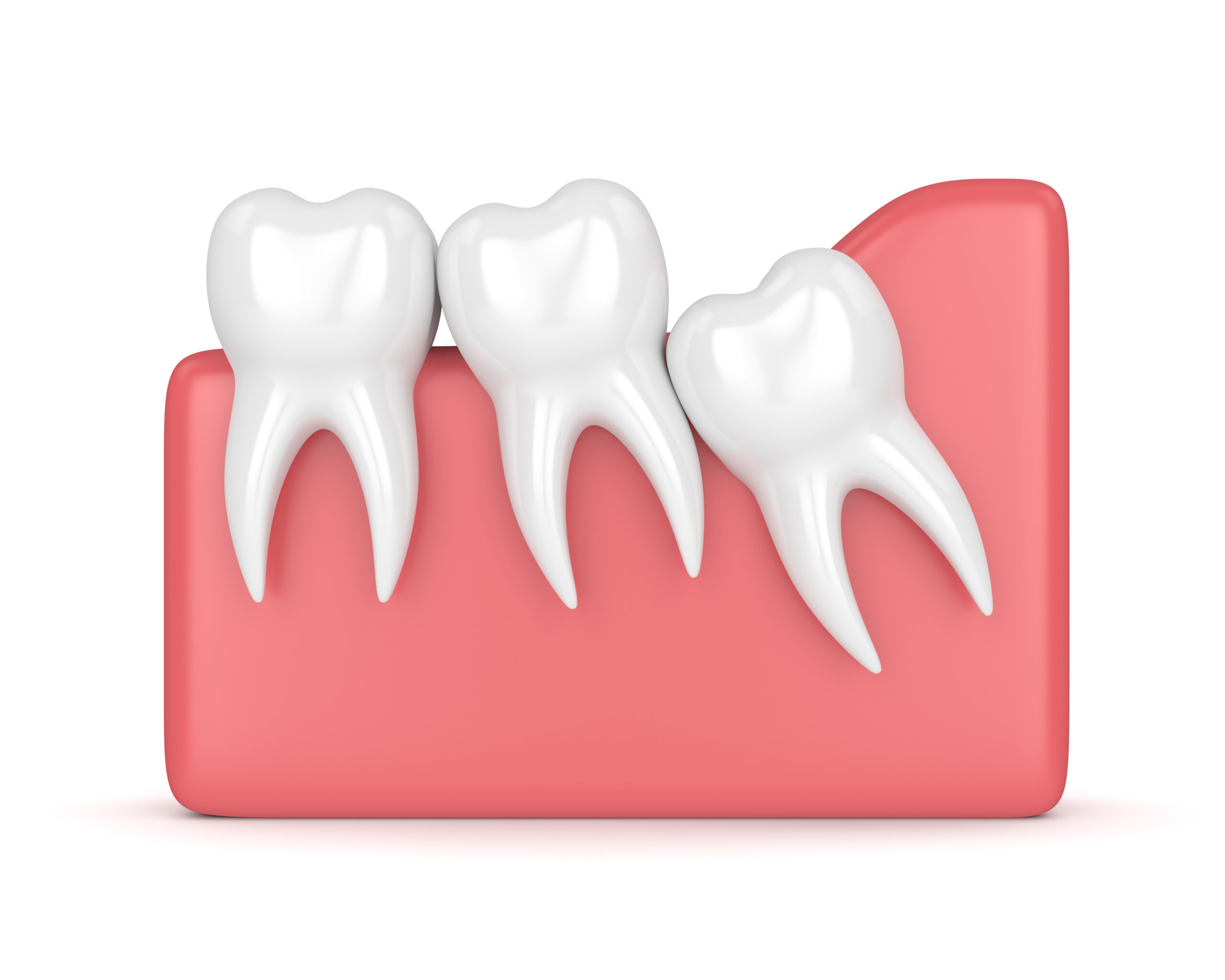 Wisdom Tooth Extraction Before, During, After