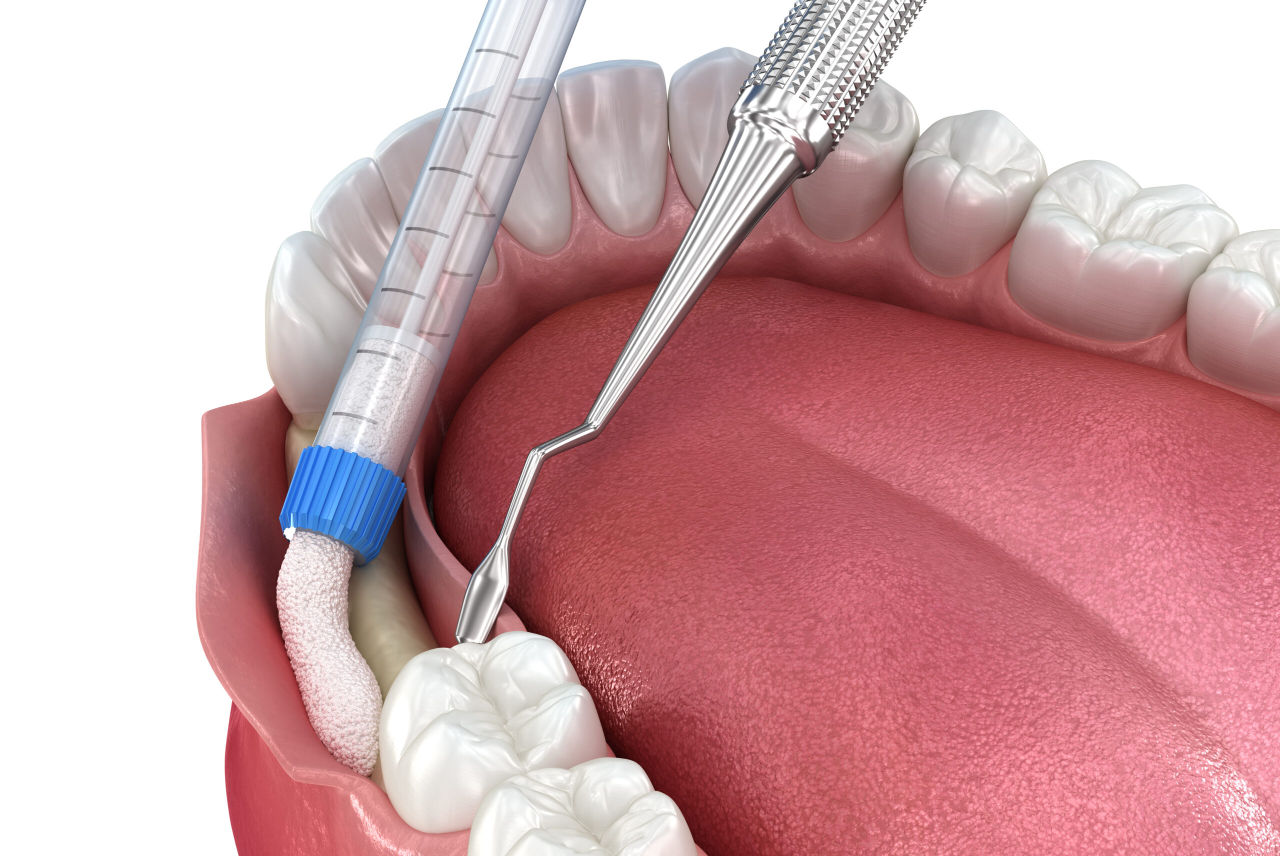 farmington bone grafting