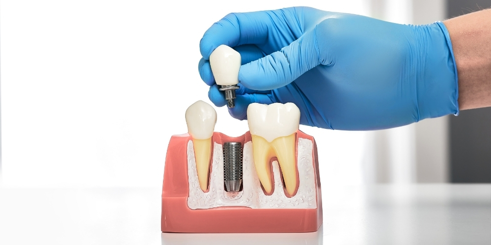 dental implants fort worth tx