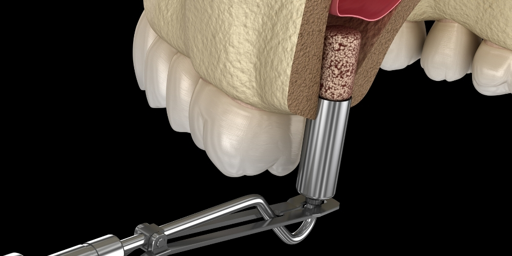 Sinus Lift